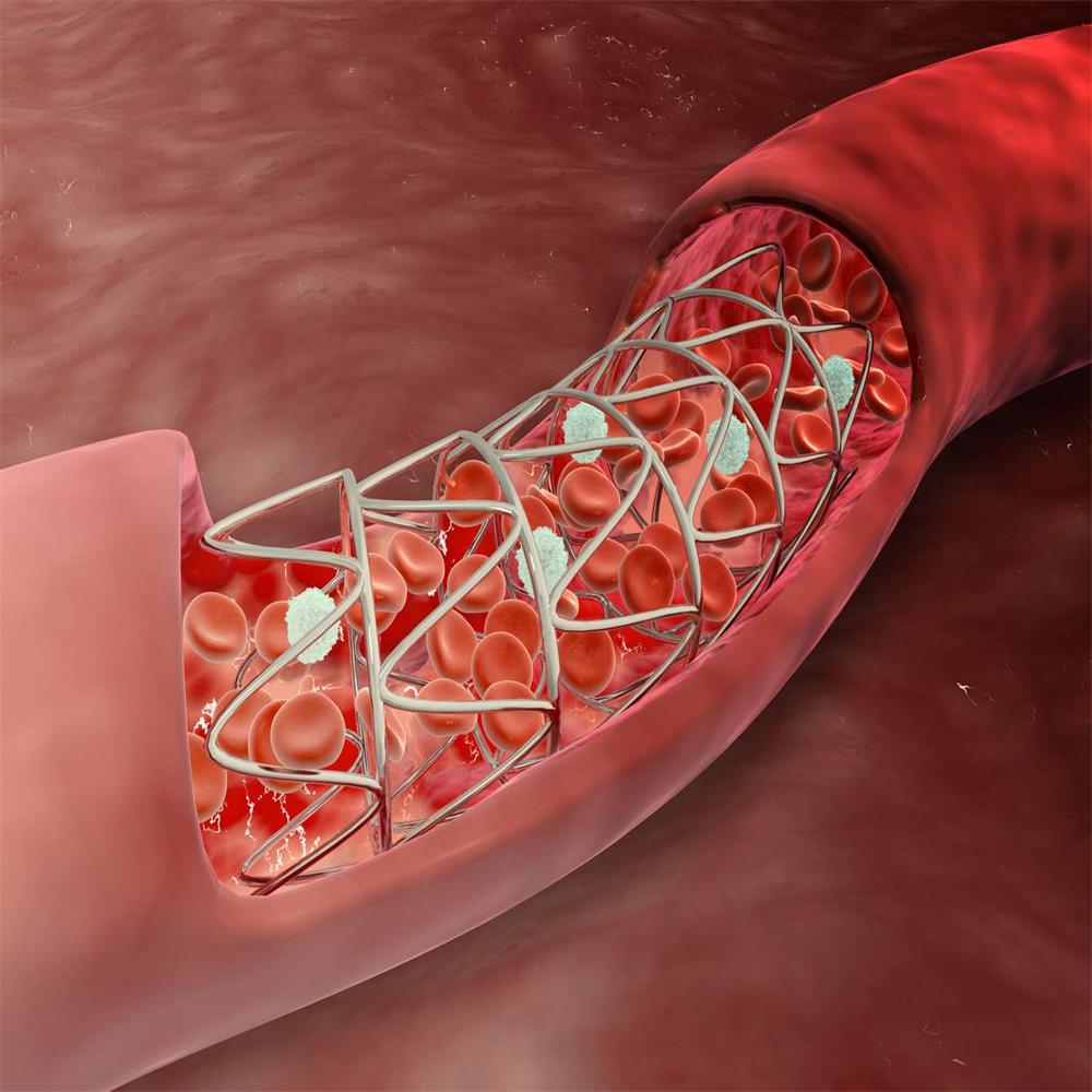 Vascular Stents